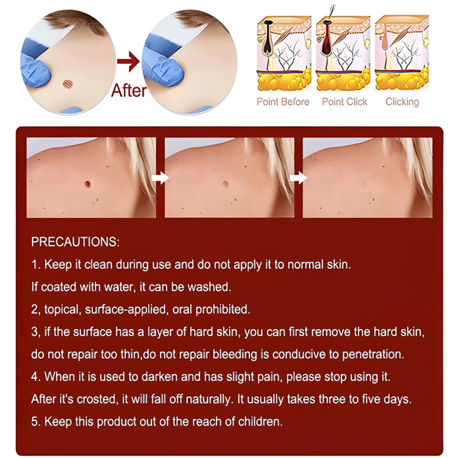 Tags & Moles Remover (Buy 1 Get 1 Free)